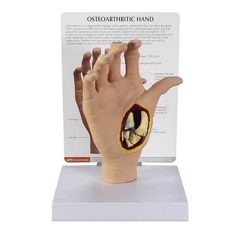 GPI Anatomicals Right Hand Model with Osteoarthritis (OA) | Human Body and Anatomy Replica for Physiology Education, Anatomical Model for Doctor's Office, Medical Learning Resources