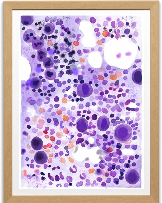 MEDPAPERS ITP Idiopathic Thrombocytopenia Bone Marrow Aspirate Hematology and Hematopathology Office Wall Art, Pathologist Hematologist Gift, Giclee (5x7 in)